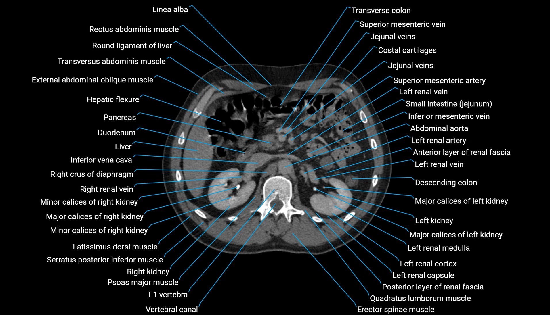 CT urogram axial cross sectional anatomy  labelled radiology image-00097.webp